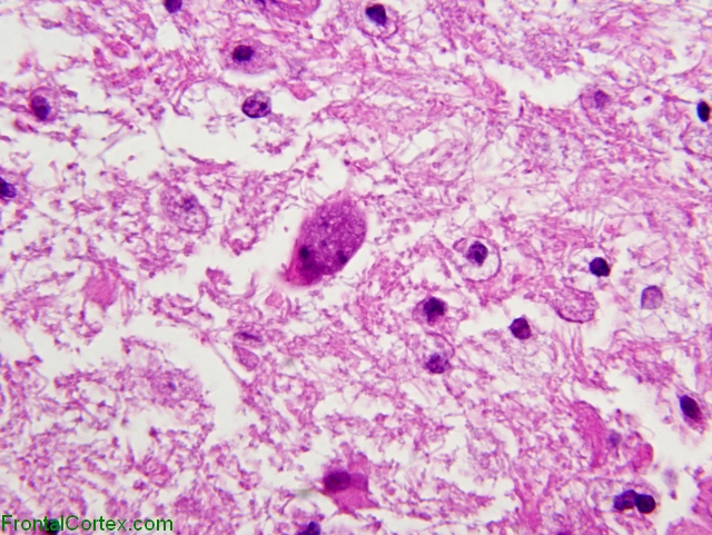 Progressive multifocal leukoencephalopathy, infected oligodendroglia cell x 600, H&E stain section.